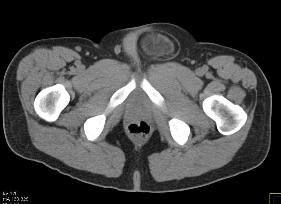 Tumor in Inguinal Ring was a Sarcoma - CTisus CT Scan