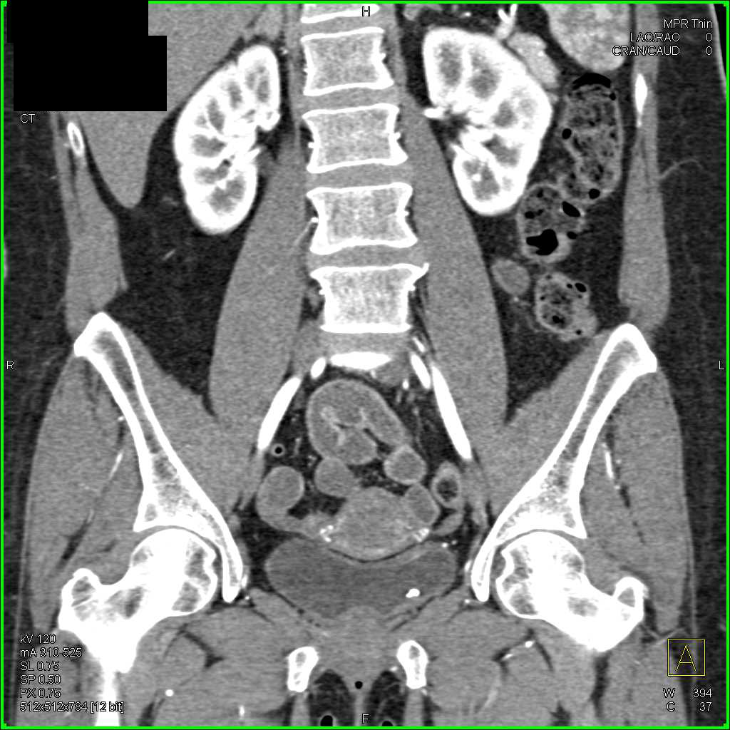 Incidental Bladder Wall Cancer with Faint Calcification - CTisus CT Scan