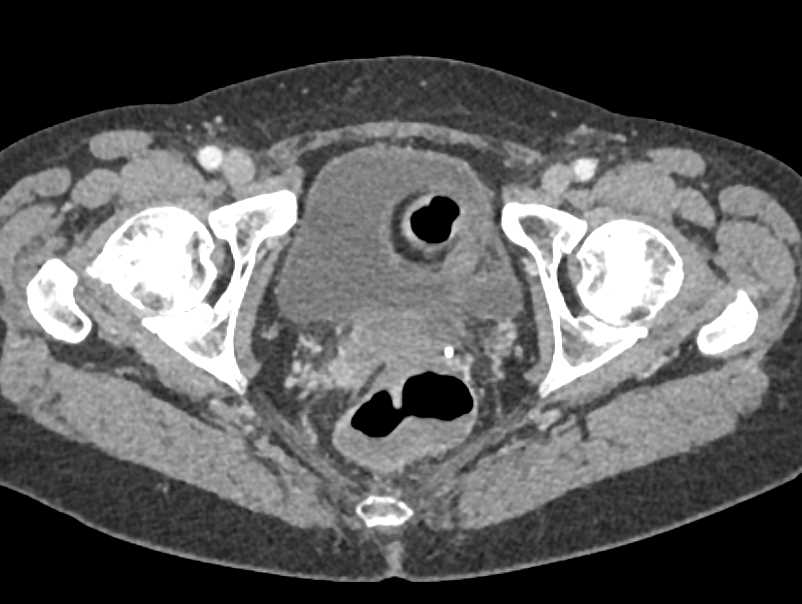 Prostate Cancer in Right Lobe of the Prostate - CTisus CT Scan