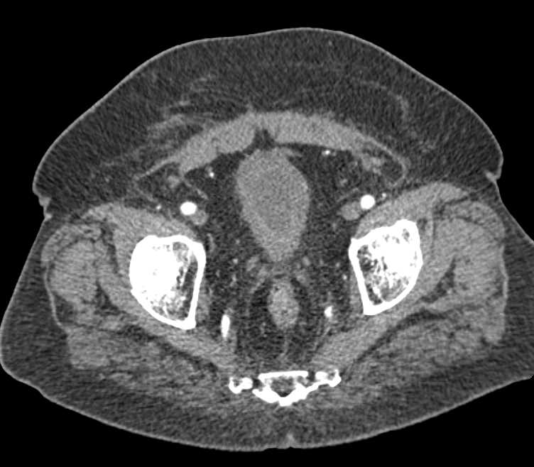 Radiation Cystitis - CTisus CT Scan