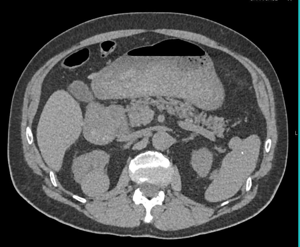 Seroma in Left Lower Quadrant with High Density Right Renal Cyst - CTisus CT Scan