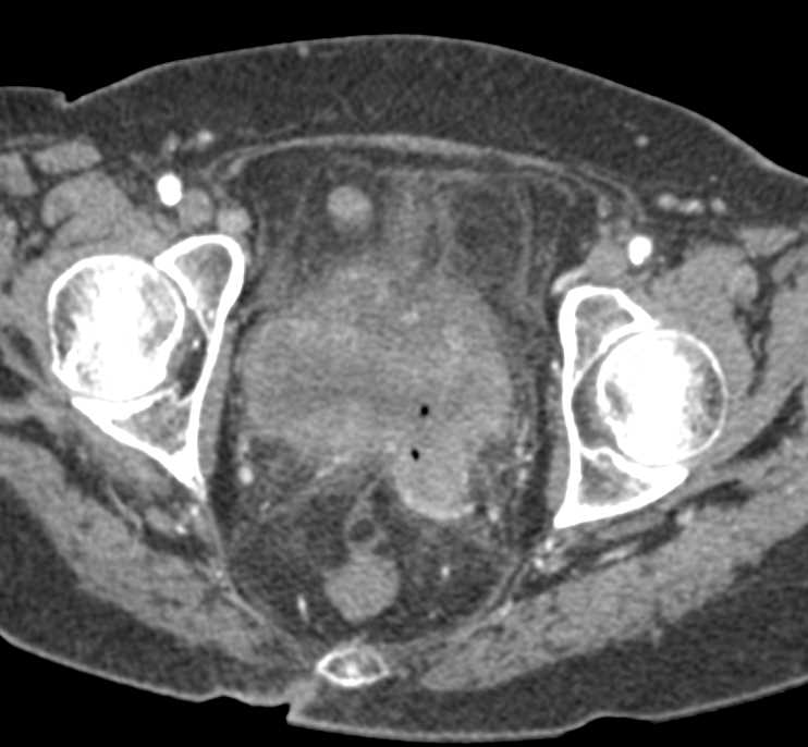 Infiltrating Bladder Cancer with Perivesical Tumor Spread - CTisus CT Scan