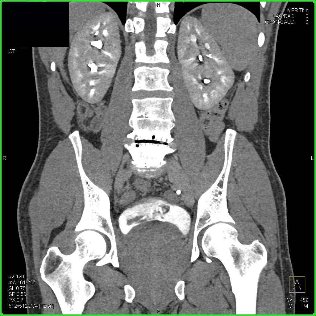 Clot Layering Out In the Bladder - CTisus CT Scan