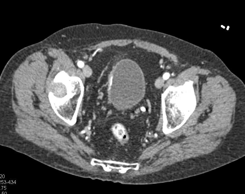 Incidental Bladder Cancer on Lateral Right Wall of Bladder with Enhancement - CTisus CT Scan