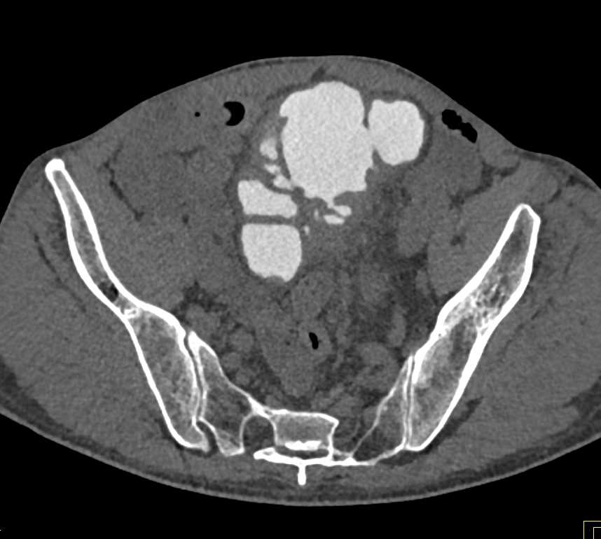 CT Cystogram with Thickened Bladder Wall and Multiple Diverticula - CTisus CT Scan