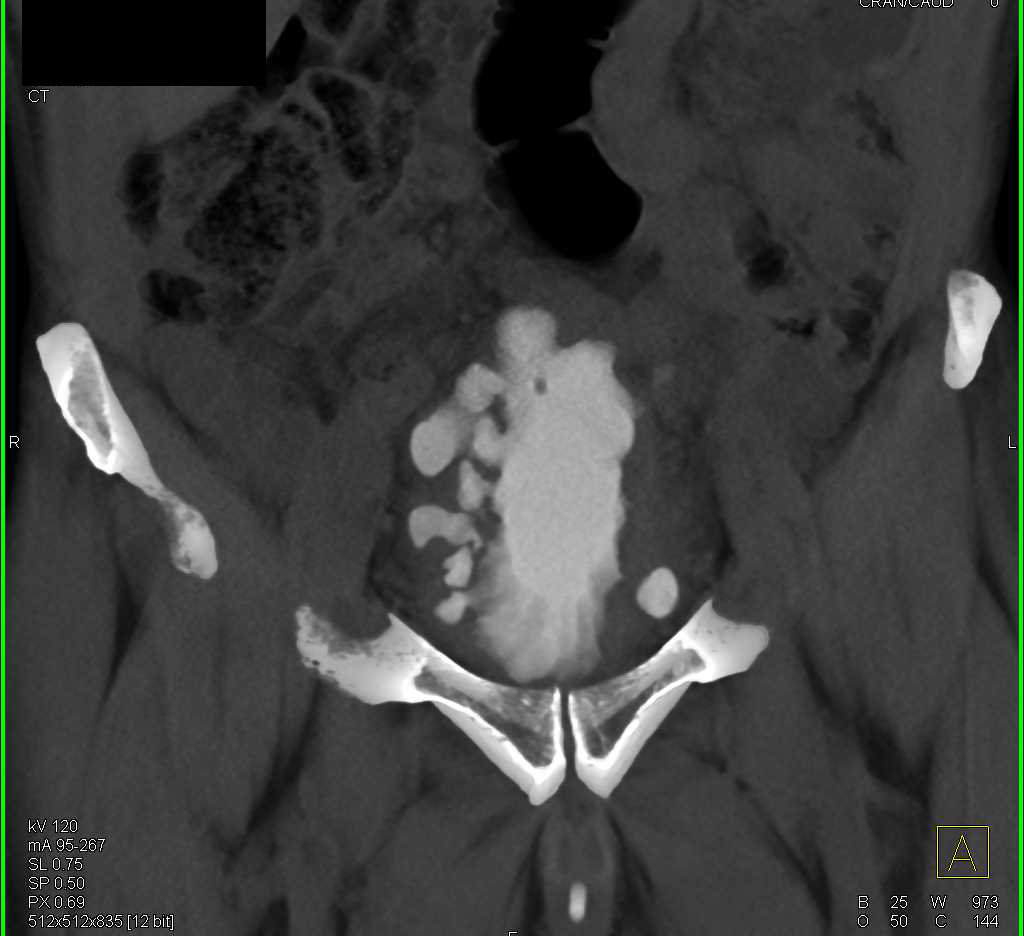 CT Cystogram with Thickened Bladder Wall and Multiple Diverticula - CTisus CT Scan