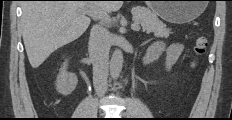 Obstructing Stone in the Right Ureter - CTisus CT Scan