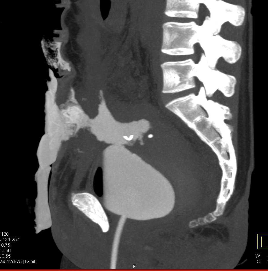 Fistulae from Bladder Into the Abdominal Wall - CTisus CT Scan