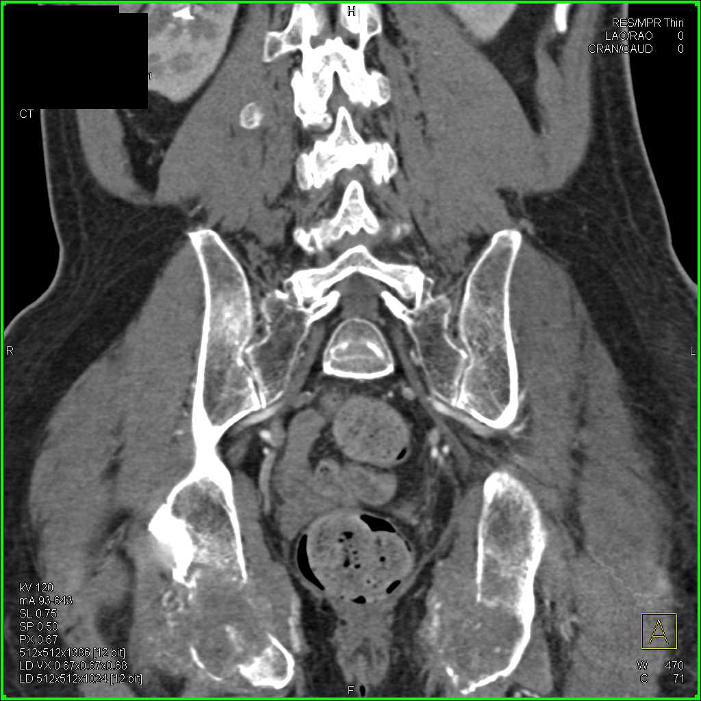 Metastatic Bladder Cancer to Bone and Lung Parenchyma - CTisus CT Scan