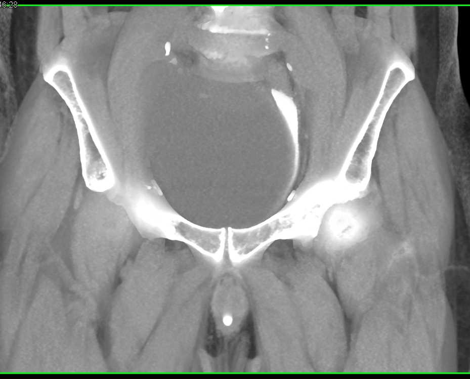 Lymphocele Compresses the Bladder - CTisus CT Scan