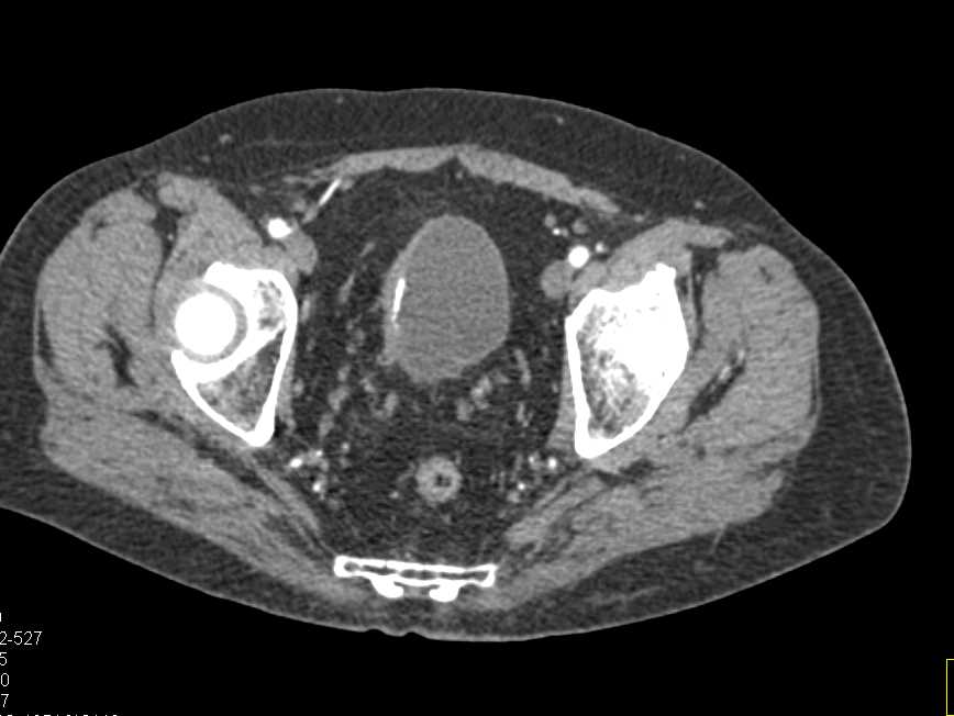 Bladder Cancer with Foci of Calcification - CTisus CT Scan