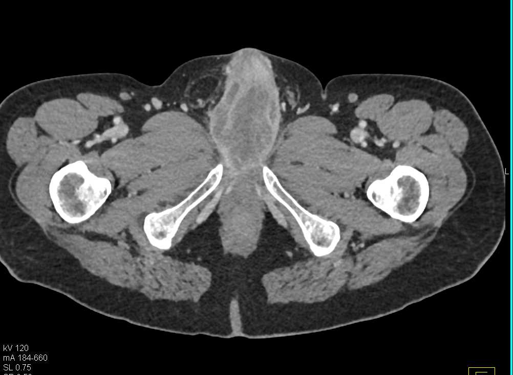 Carcinoma of the Penile Urethra - CTisus CT Scan