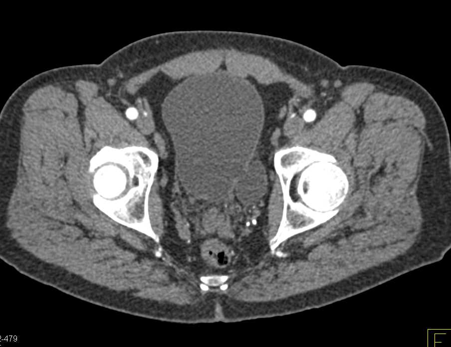 Bladder Diverticulum - CTisus CT Scan