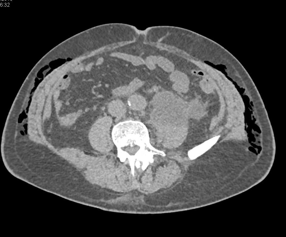 Urinoma due to Leak from the Ureter - CTisus CT Scan