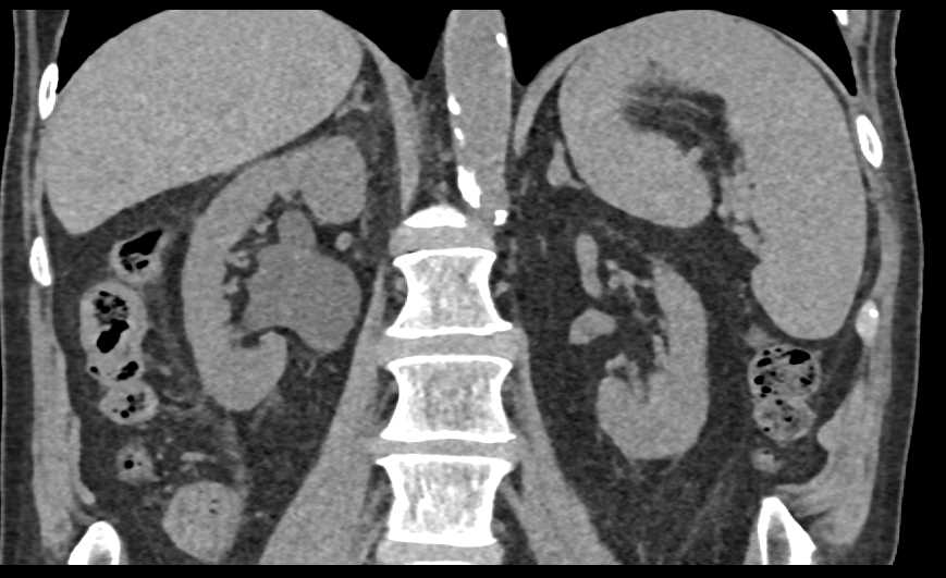 Bladder Cancer Involves the Distal Right Ureter - CTisus CT Scan