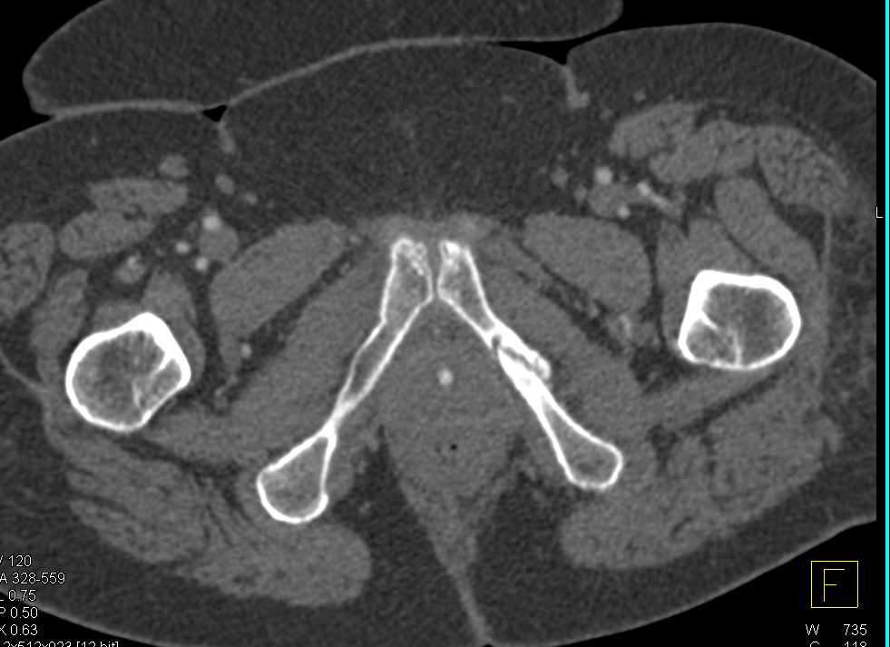Pelvic Trauma Without Bladder Injury - CTisus CT Scan