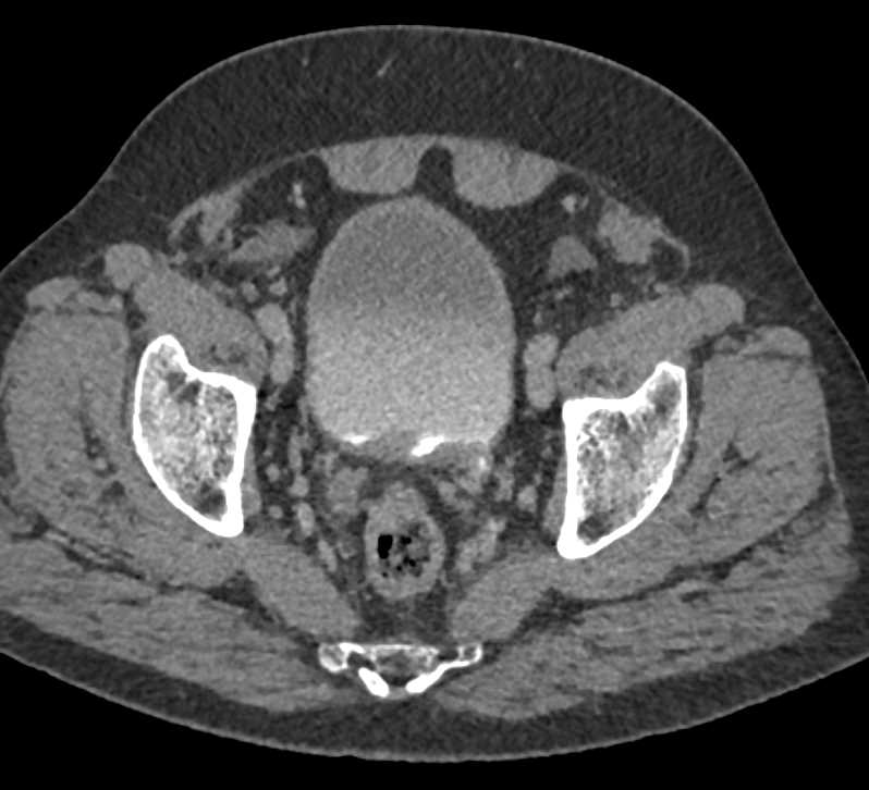 Carcinoma Distal Left Ureter - CTisus CT Scan