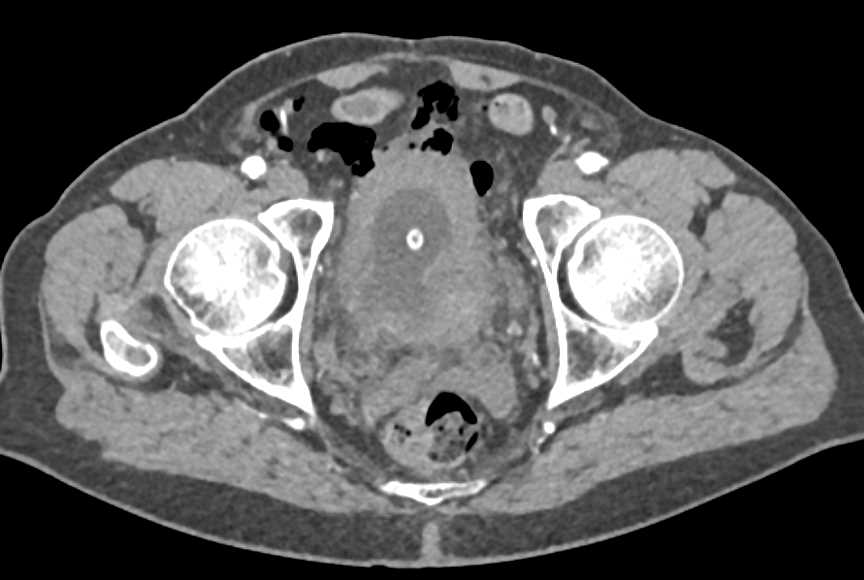 Bladder Perforation s/p Cystoscopy - CTisus CT Scan