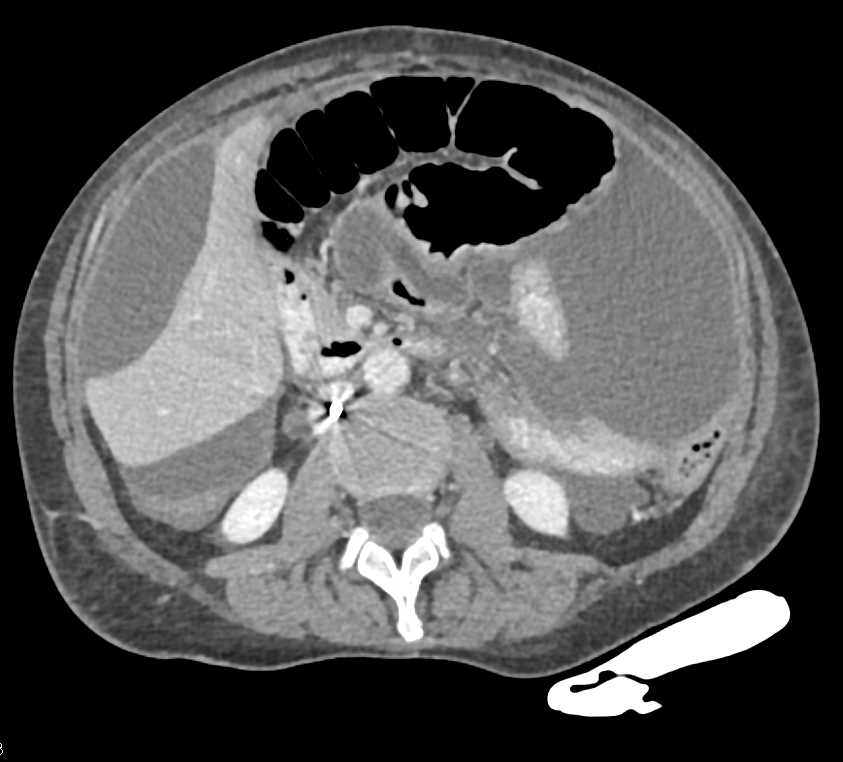 Ascites and Bladder Leak - CTisus CT Scan