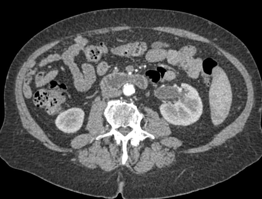 Obstructed Bilateral Ureters due to Infiltrating Bladder Cancer on Bx - CTisus CT Scan