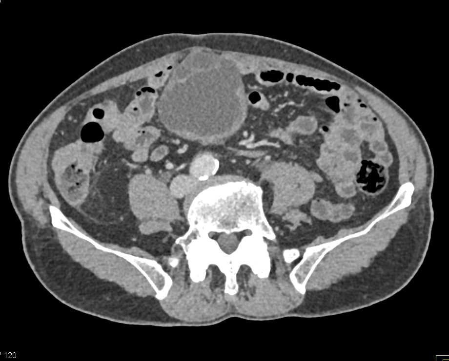 Bladder Cancer with Hemorrhage - CTisus CT Scan