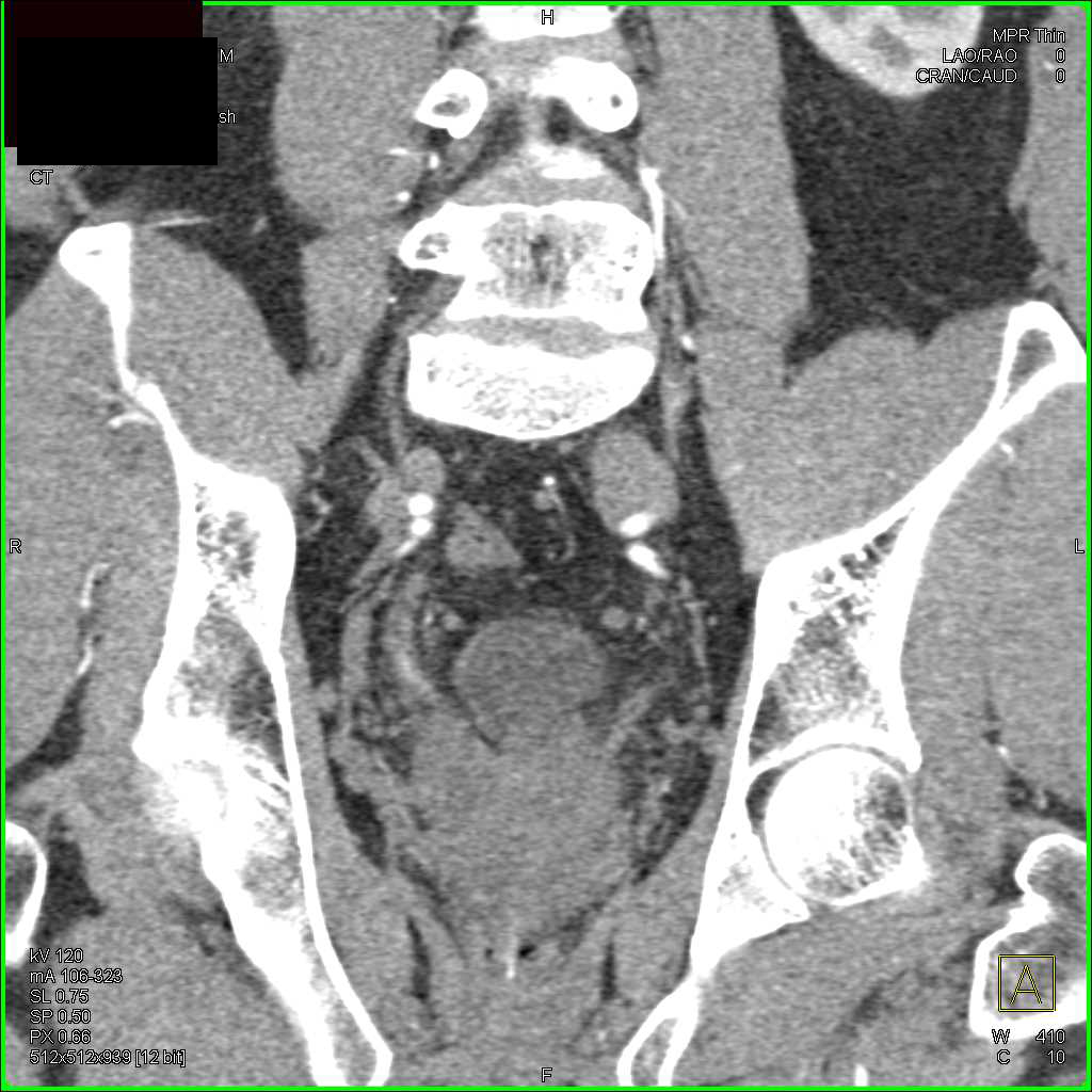Prostate Cancer - CTisus CT Scan