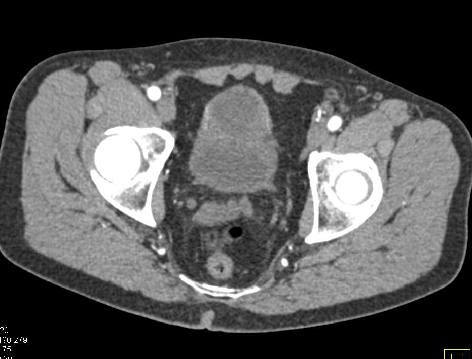 Prostate Cancer - CTisus CT Scan