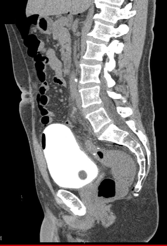 Normal CT Cystogram - CTisus CT Scan