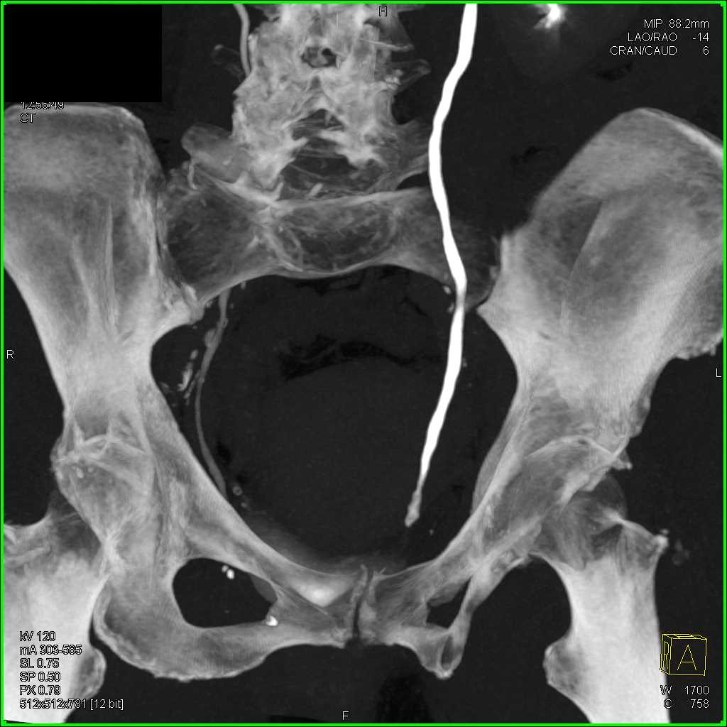 Transitional Cell Carcinoma (TCC) Distal Left Ureter - CTisus CT Scan