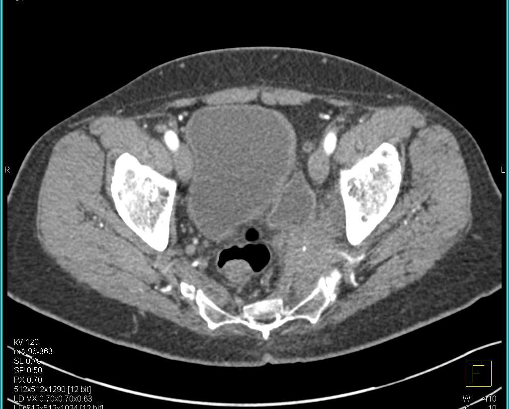 Bladder Cancer Involves the Left Pelvic Side Wall and Obstructs the Left Ureter. - CTisus CT Scan