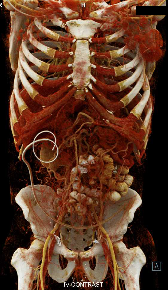 Peritoneal Dialysis Catheter with Cinematic Rendering - CTisus CT Scan