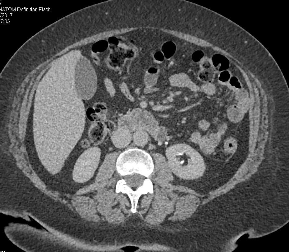 Stone in the Distal Left Ureter - CTisus CT Scan
