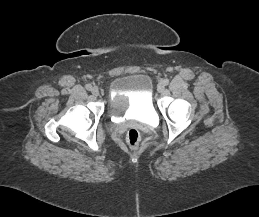 Bladder Cancer - CTisus CT Scan