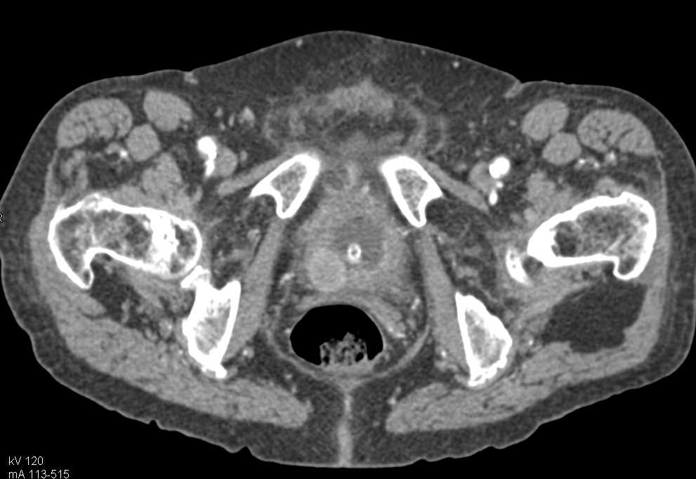 Bladder Cancer - CTisus CT Scan