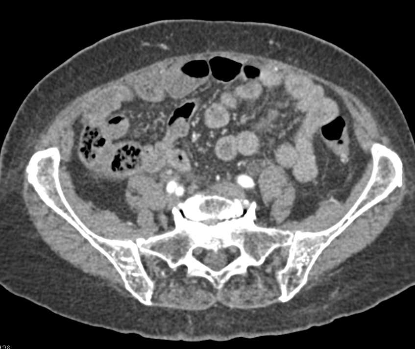 Bulky Bladder Cancer - CTisus CT Scan