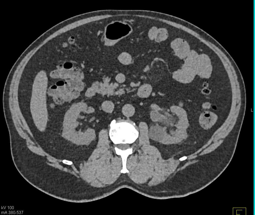 Transitional Cell Carcinoma (TCC) Left Ureter - CTisus CT Scan