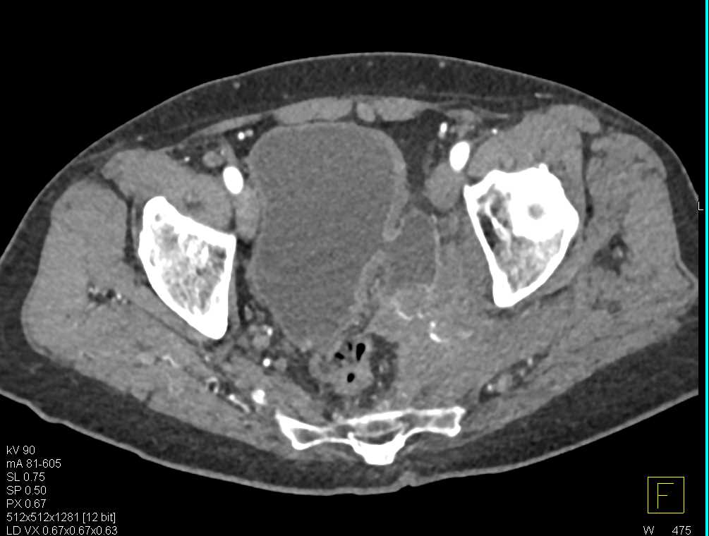 Bladder Cancer Involves the Pelvic Side Wall - CTisus CT Scan