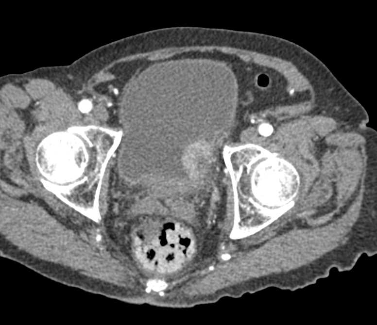 Bladder Cancer Along the Left Bladder Wall - CTisus CT Scan