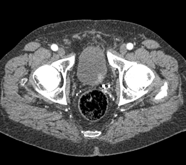 Incidental 1cm Bladder Cancer - CTisus CT Scan