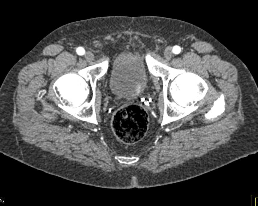 Incidental 1cm Bladder Cancer - CTisus CT Scan
