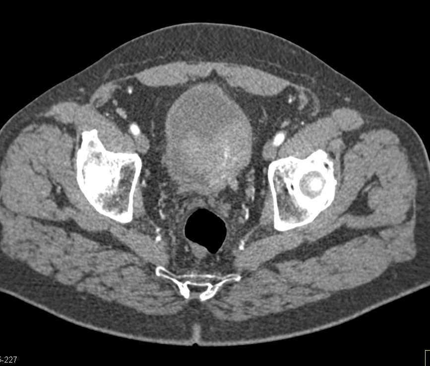 Bladder Cancer with Blood in the Bladder - CTisus CT Scan