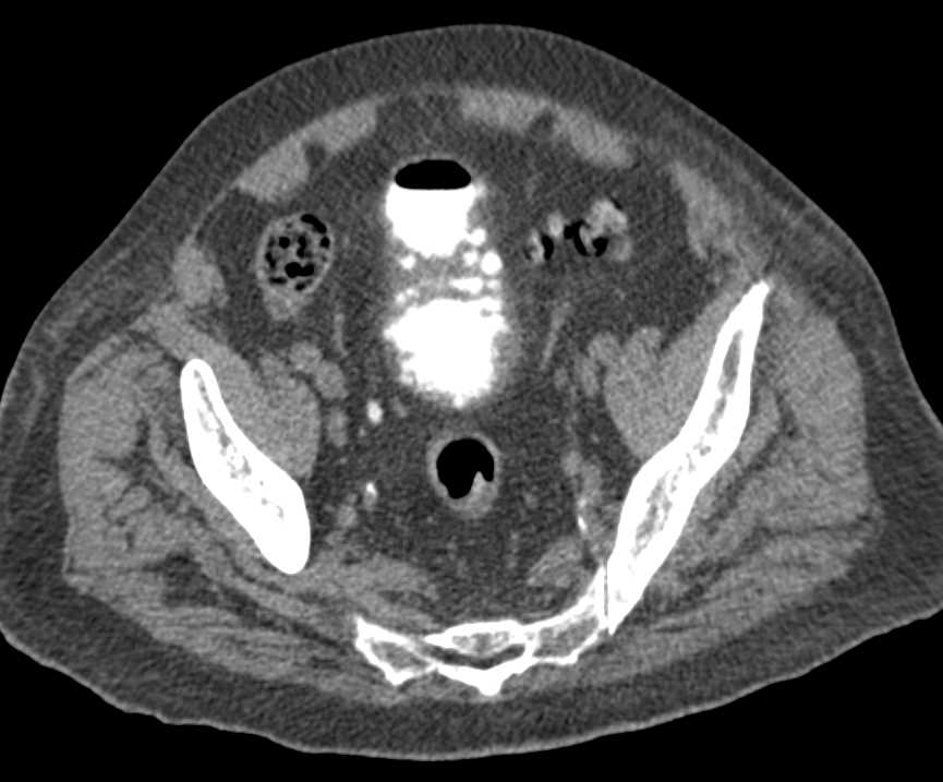 Blood Clots in the Bladder - CTisus CT Scan
