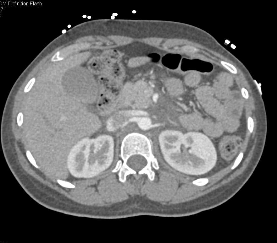 Retroperitoneal Bleed s/p Gunshot Wound (GSW) - CTisus CT Scan