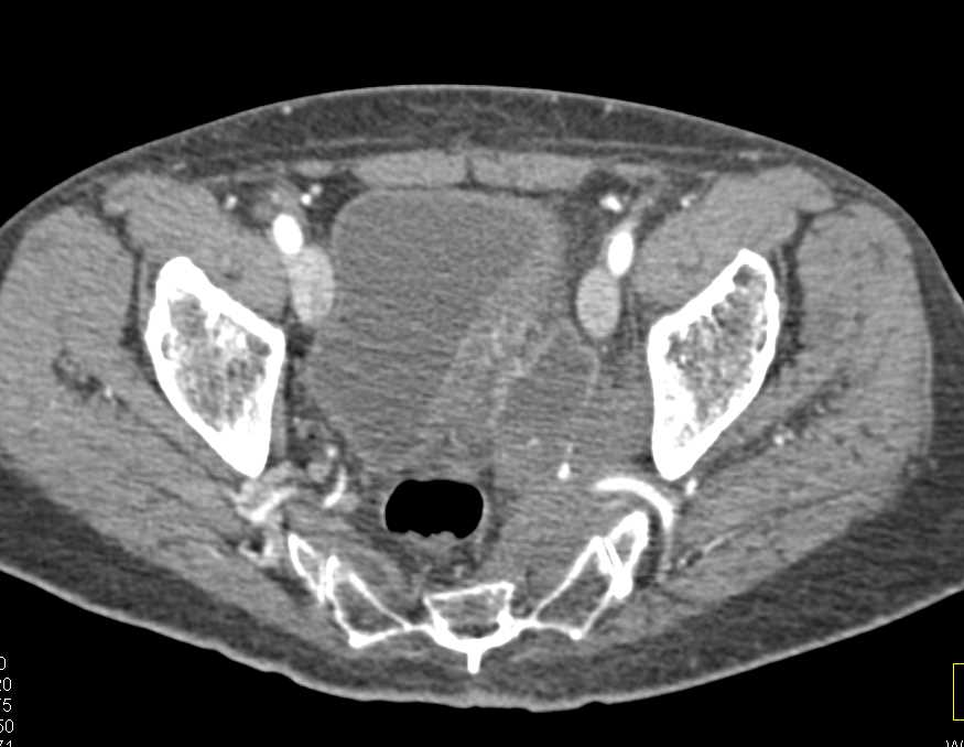 Aggressive Bladder Cancer with Pelvic Side Wall Invasion - CTisus CT Scan
