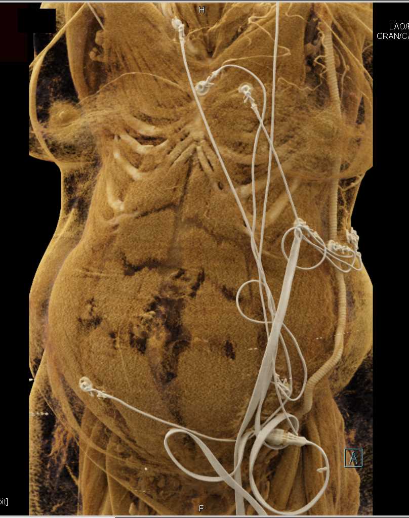 Left Retroperitoneal Bleed - CTisus CT Scan