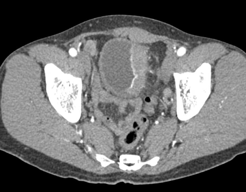 Bladder Cancer with left Hydronephrosis - CTisus CT Scan