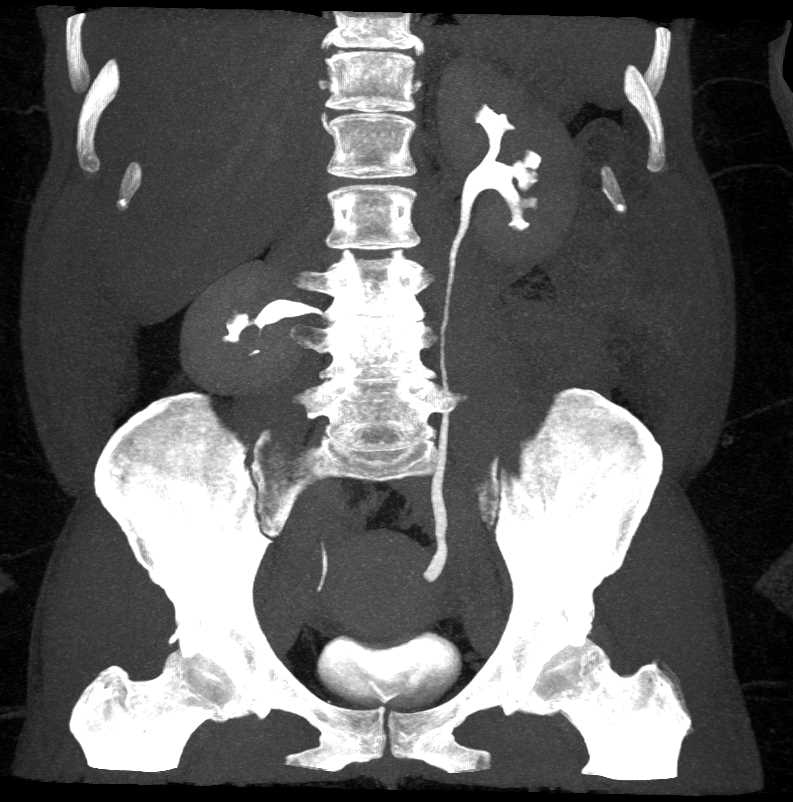 Ureterocele Left Ureter - CTisus CT Scan