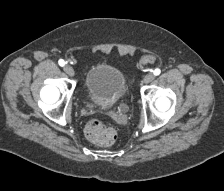 Bladder Cancer - CTisus CT Scan