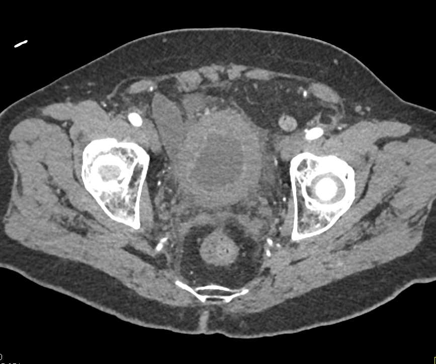 Cystitis with Thick Walled Bladder - CTisus CT Scan