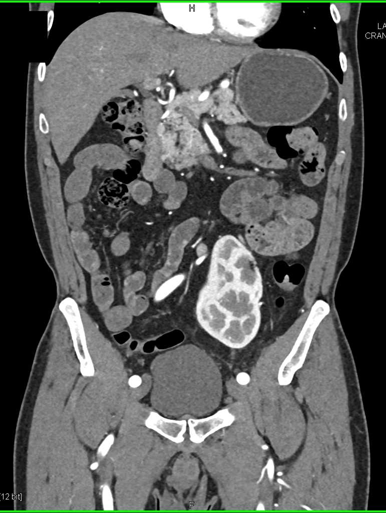 Multiple Calculi Distal Left Ureter - CTisus CT Scan